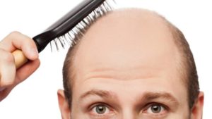 best Hair Loss & Alopecia